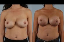 before and after breast revision female patient front view case 3244
