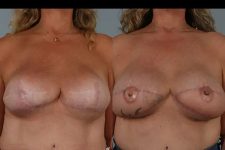 before and after breast revision female patient front view case 3271