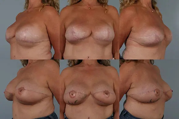 before and after breast revision female patient multiple angle view case 3271