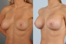 before and after breast revision female patient left diagonal view case 3276