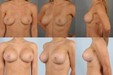 before and after breast revision female patient multiple angle view case 3276