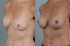 before and after breast revision female patient left diagonal view case 3279