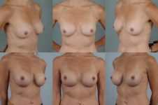 before and after breast revision female patient multiple angle view case 3279