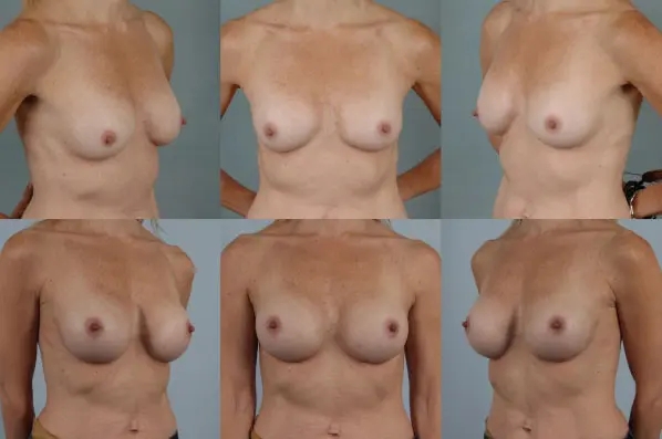 before and after breast revision female patient multiple angle view case 3279