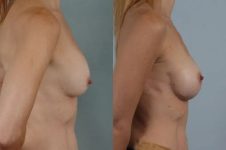 before and after breast revision female patient right side view case 3279