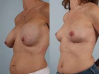 before and after breast revision female patient left diagonal view case 3294