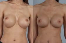 before and after breast revision female patient front view case 3305