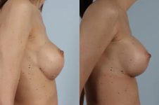 before and after breast revision female patient right side view case 3305