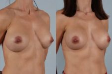 before and after breast revision female patient right diagonal view case 3319