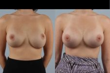 before and after breast revision female patient front view case 3331