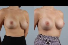 before and after breast revision female patient right diagonal view case 3331