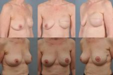 before and after breast revision female patient multiple angle view case 3391