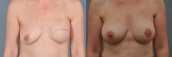 before and after breast revision female patient front view case 3391