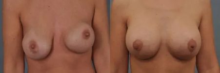 before and after breast revision female patient front view case 3394