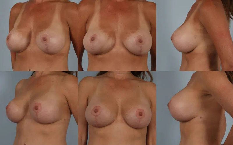 before and after breast revision female patient multiple angle view case 3419