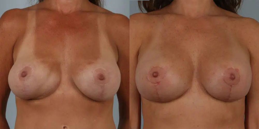 before and after breast revision female patient front view case 3419