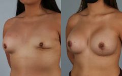 before and after breast revision female patient left diagonal view case 3461