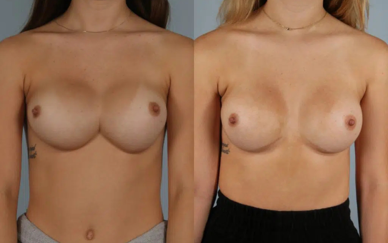 before and after breast revision female patient front view case 3443
