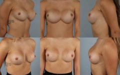 before and after breast revision female patient multiple angle view case 3443