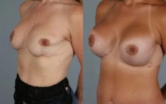 before and after breast revision female patient left diagonal view case 3432