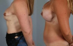 before and after breast revision female patient left side view case 3432