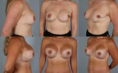 before and after breast revision female patient multiple angle view case 3432