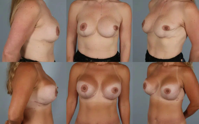 before and after breast revision female patient multiple angle view case 3432