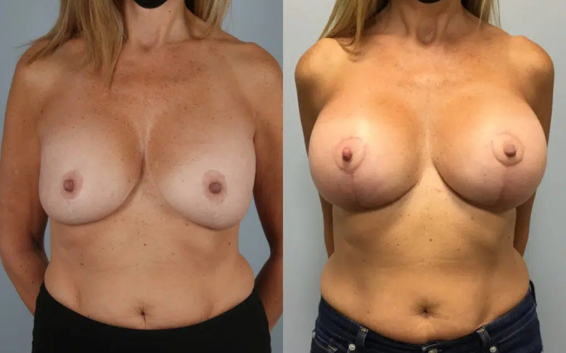 before and after breast revision female patient front view case 3427
