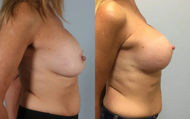 before and after breast revision female patient right side view case 3427