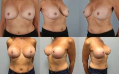 before and after breast revision female patient multiple angle view case 3427
