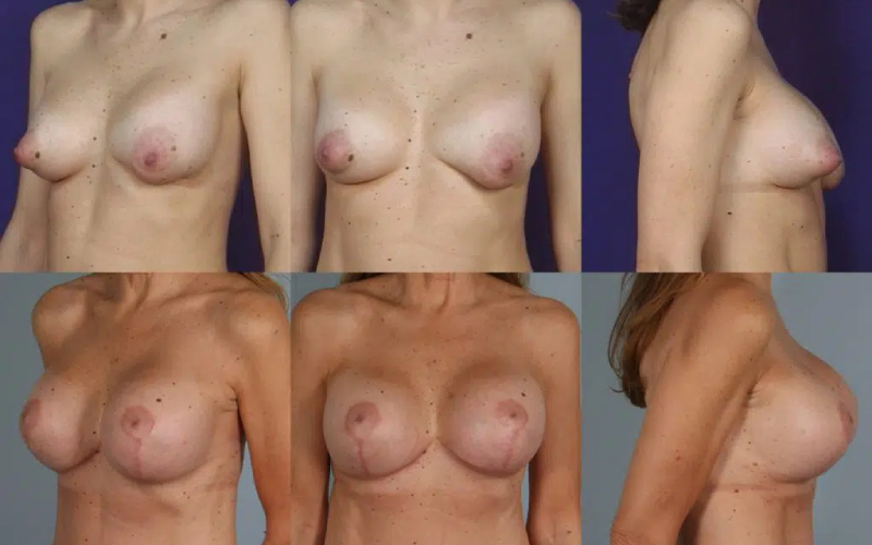 before and after breast revision female patient multiple angle view case 3422