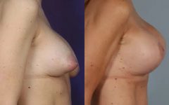 before and after breast revision female patient right side view case 3422