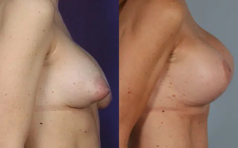 before and after breast revision female patient right side view case 3422