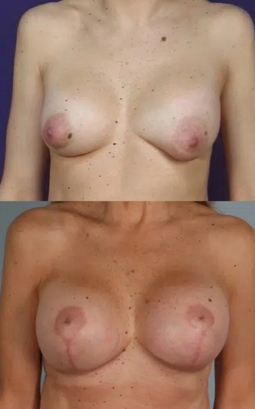 before and after breast revision female patient front view case 3422