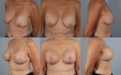 before and after breast revision female patient multiple angle view case 3414
