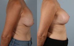 before and after breast revision female patient right side view case 3414