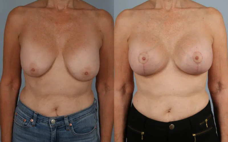 before and after breast revision female patient front view case 3414