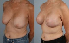 before and after breast revision female patient left diagonal view case 3414