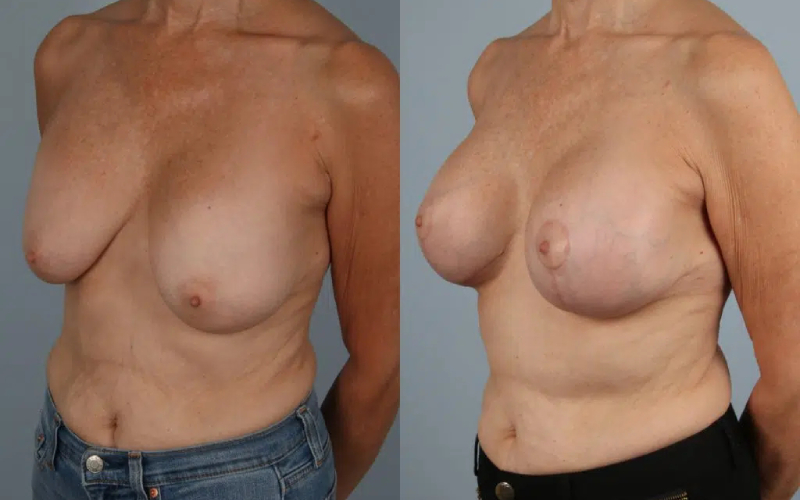 before and after breast revision female patient left diagonal view case 3414