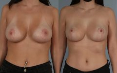 before and after breast revision female patient front view case 3077