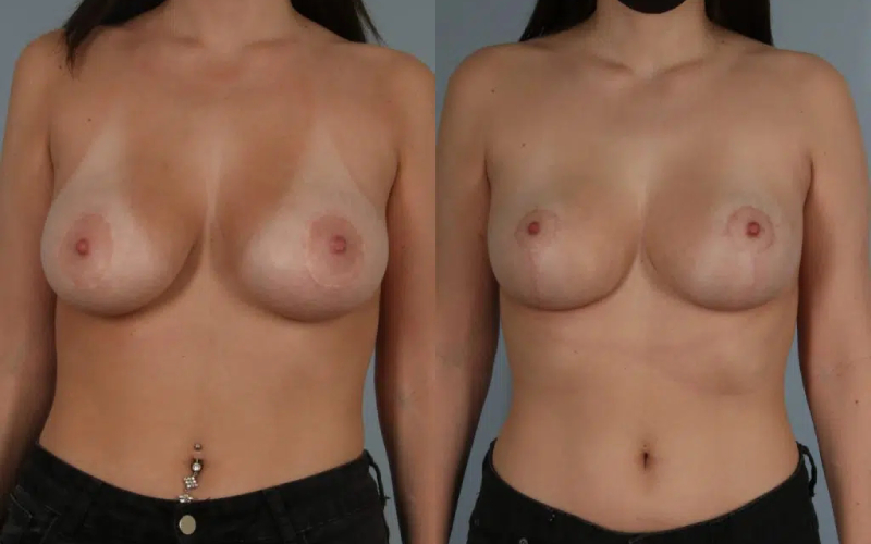 before and after breast revision female patient front view case 3077