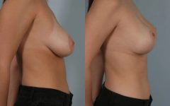 before and after breast revision female patient right side view case 3077
