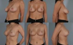 before and after breast revision female patient multiple angle view case 3077