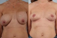 before and after breast revision front view case 3294
