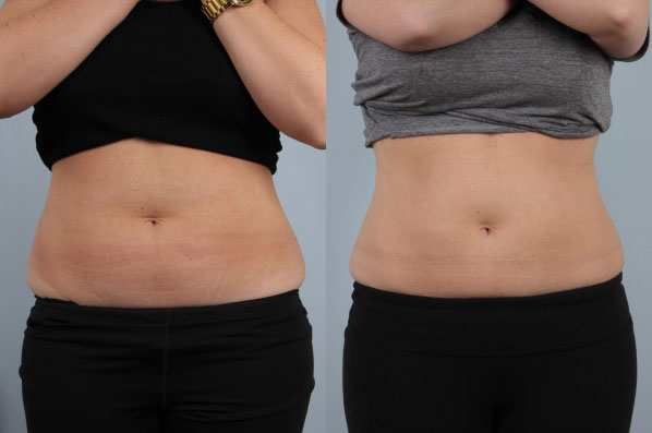 before and after coolsculpting front view female patient case 697