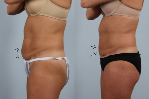 before and after coolsculpting left side view female patient case 700