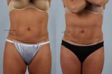 before and after coolsculpting front view female patient case 700