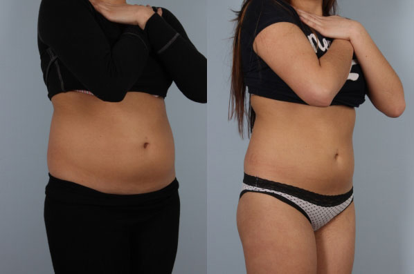 before and after coolsculpting right view female patient case 706
