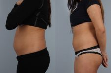 before and after coolsculpting left side view female patient case 706
