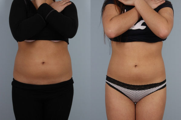 before and after coolsculpting front view female patient case 706